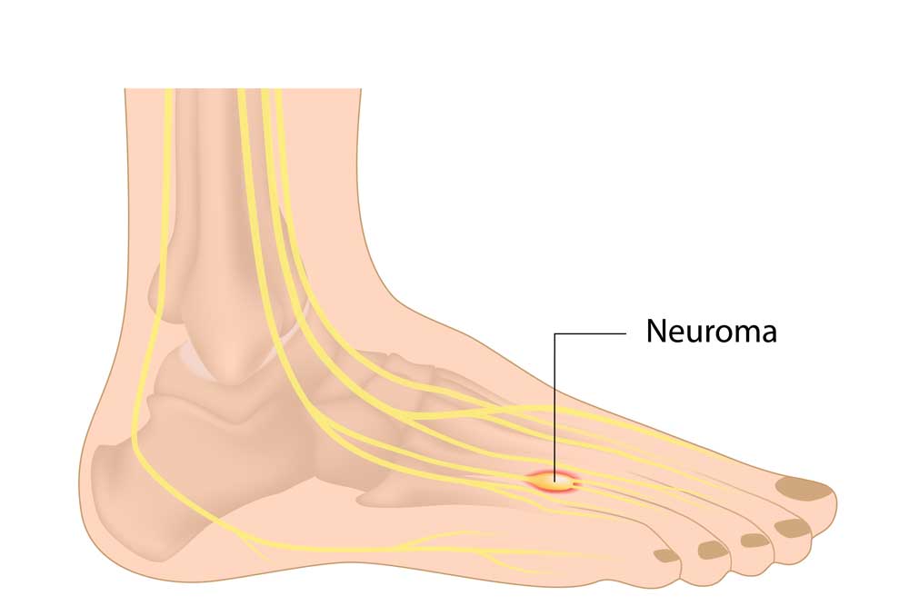 Neuroma Hamilton Foot And Ankle Care